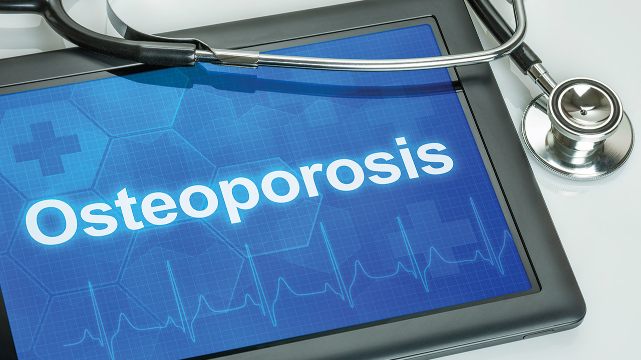 10 Warning Signs of Osteoporosis-Image
