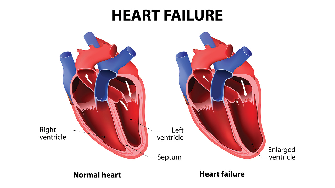 Understanding Heart Failure in the Elderly