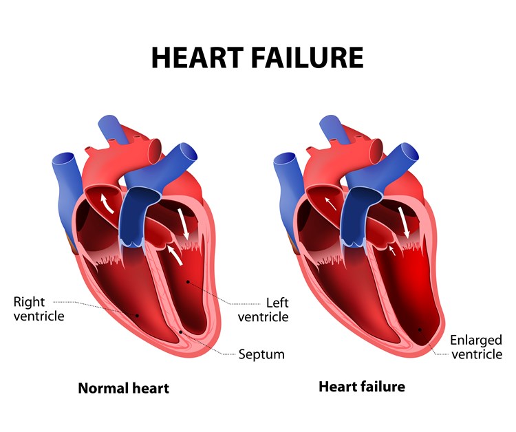 What is the life expectancy of end-stage congestive heart failure?